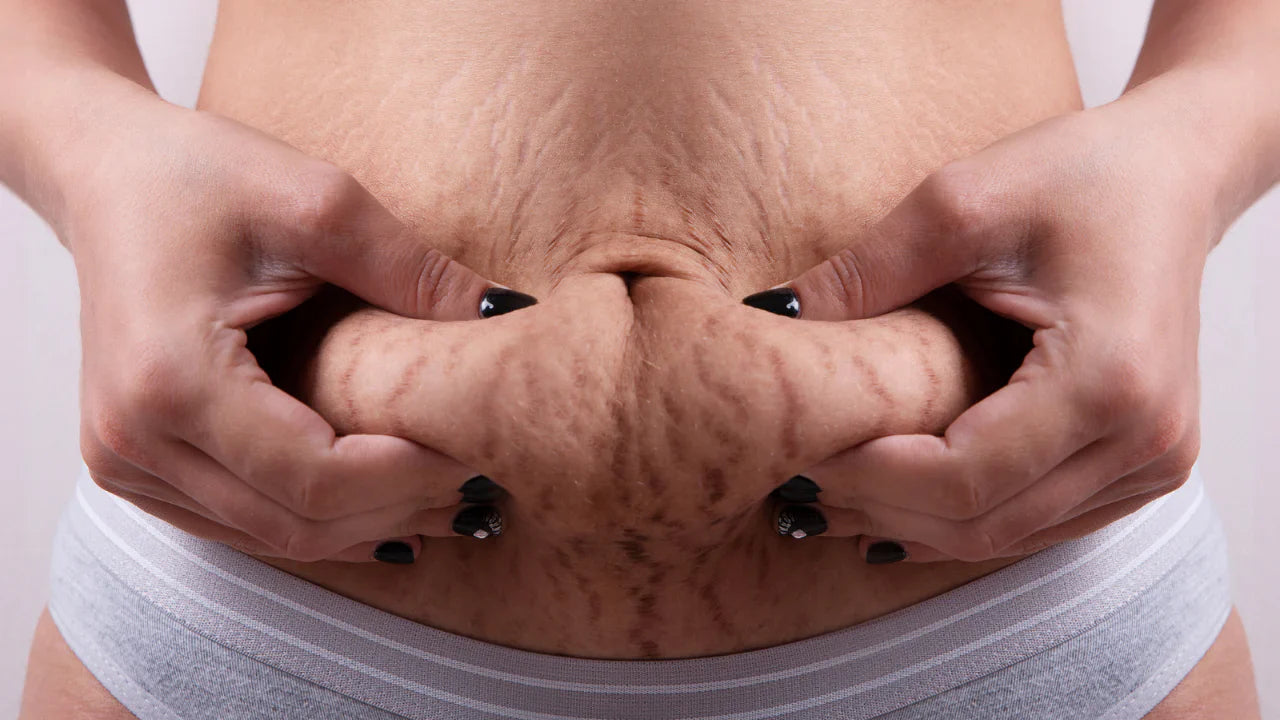 Stretch Marks After Pregnancy? Here’s How to Fade Them Naturally at Home