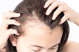 Why Do Pakistani Moms Experience Hair Fall After Pregnancy? Causes & Natural Treatments