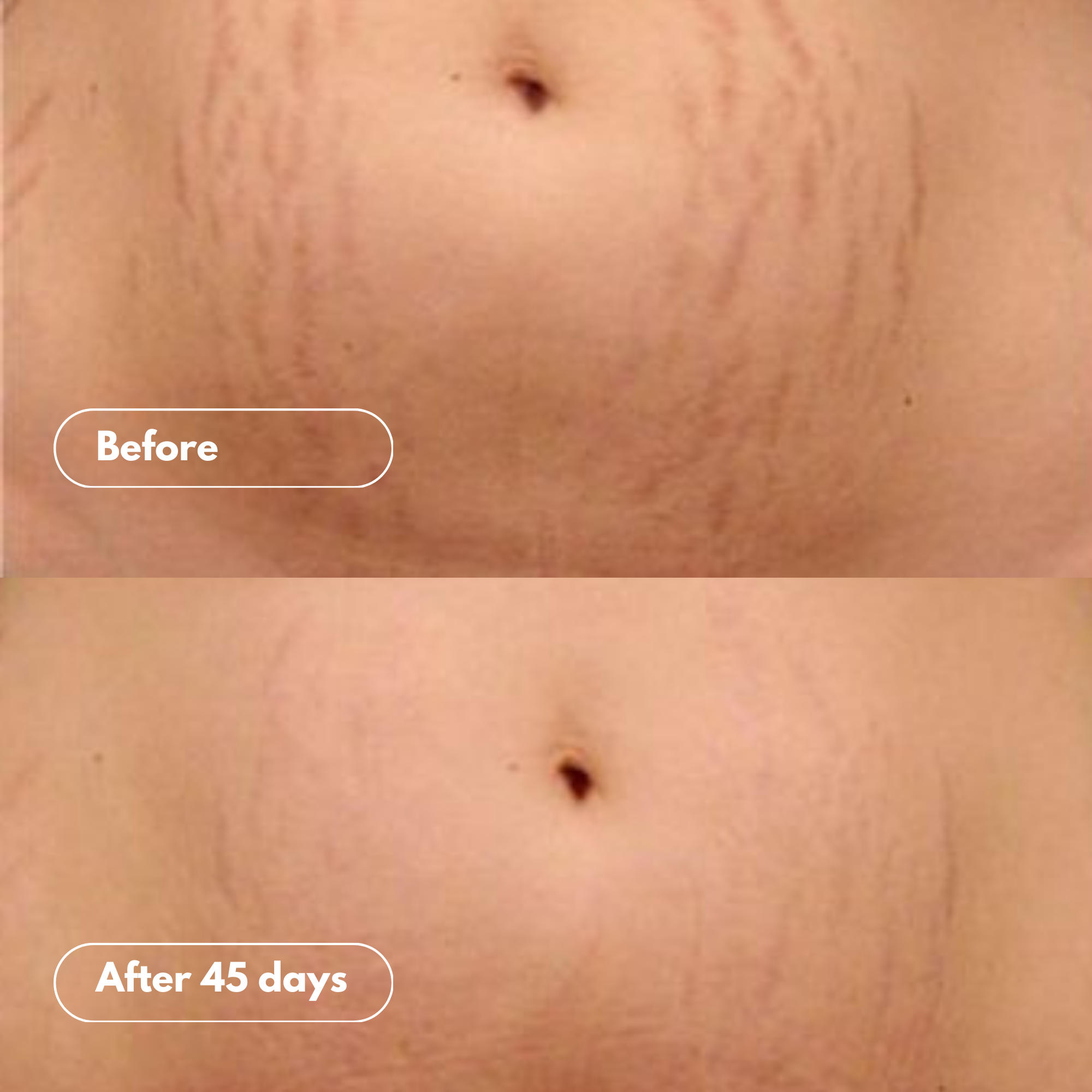 Stretch Marks & Scar Belly Balm